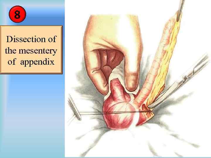 8 Dissection of the mesentery of appendix 