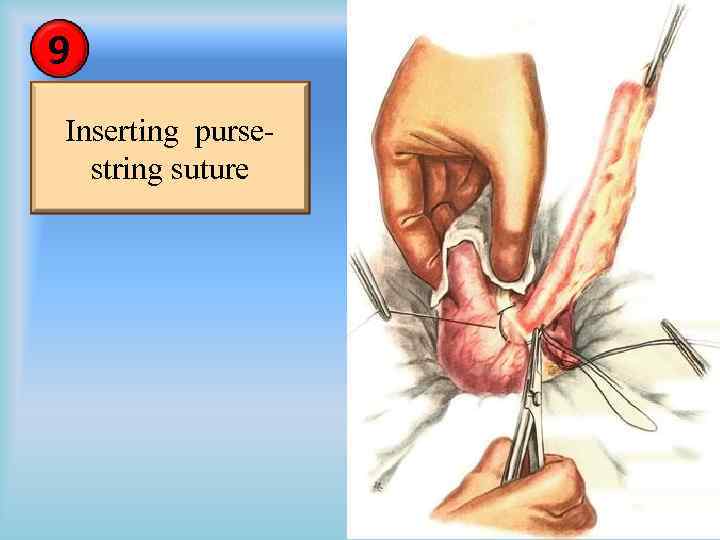 9 Inserting pursestring suture 