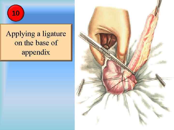 10 Applying a ligature on the base of appendix 