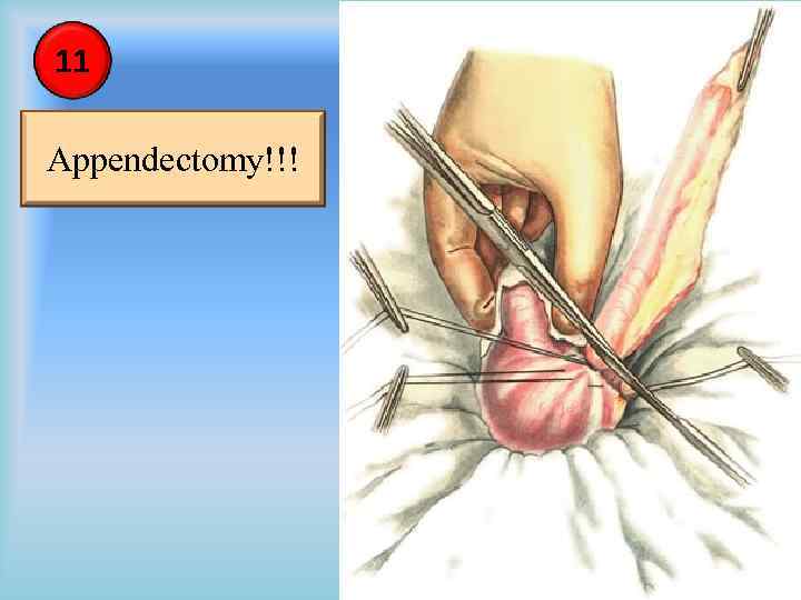 11 Appendectomy!!! 