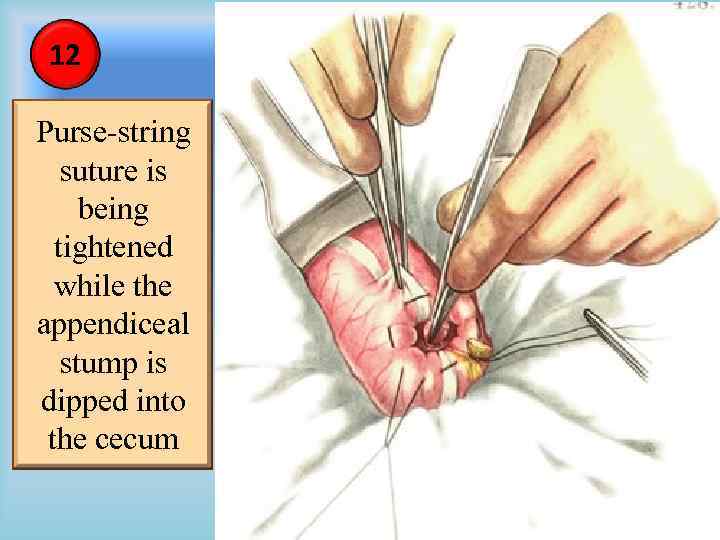 12 Purse-string suture is being tightened while the appendiceal stump is dipped into the