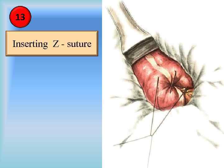 13 Inserting Z - suture 