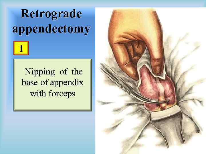 Retrograde appendectomy 1 Nipping of the base of appendix with forceps 