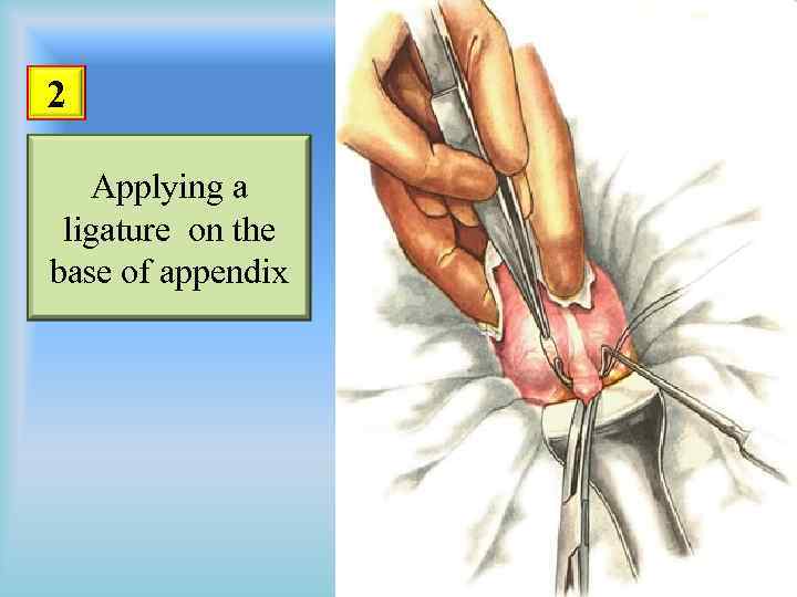 2 Applying a ligature on the base of appendix 