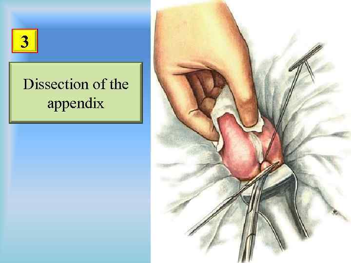 3 Dissection of the appendix 