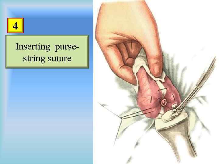 4 Inserting pursestring suture 