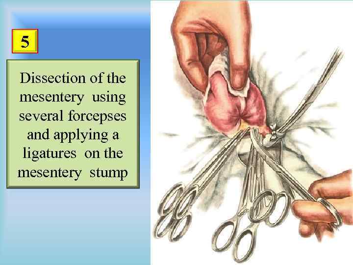 5 Dissection of the mesentery using several forcepses and applying a ligatures on the