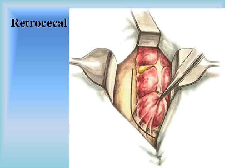 Retrocecal 