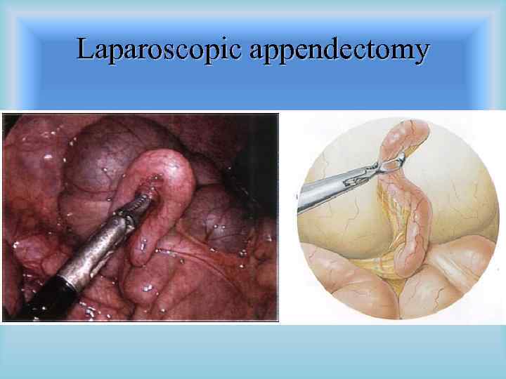 Laparoscopic appendectomy 