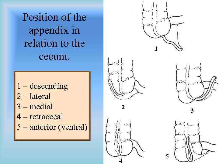 Position of the appendix in relation to the cecum. 1 – descending 2 –