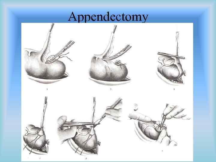 Appendectomy Development Of The Digestive System A