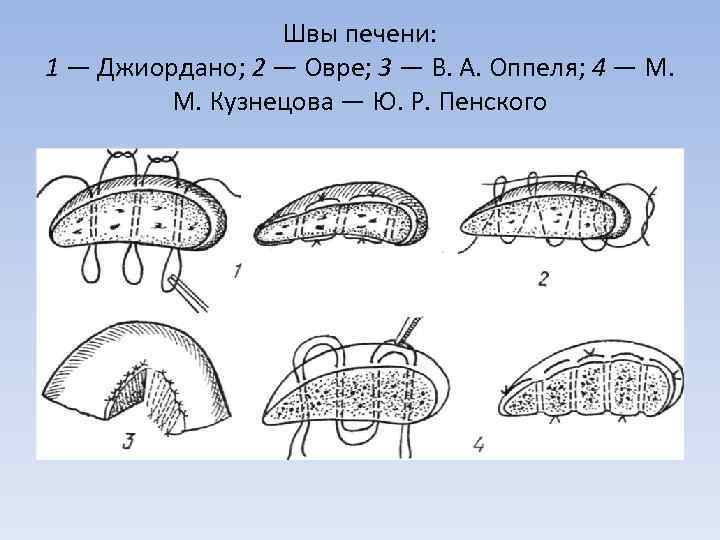 Швы печени: 1 — Джиордано; 2 — Овре; 3 — В. А. Оппеля; 4