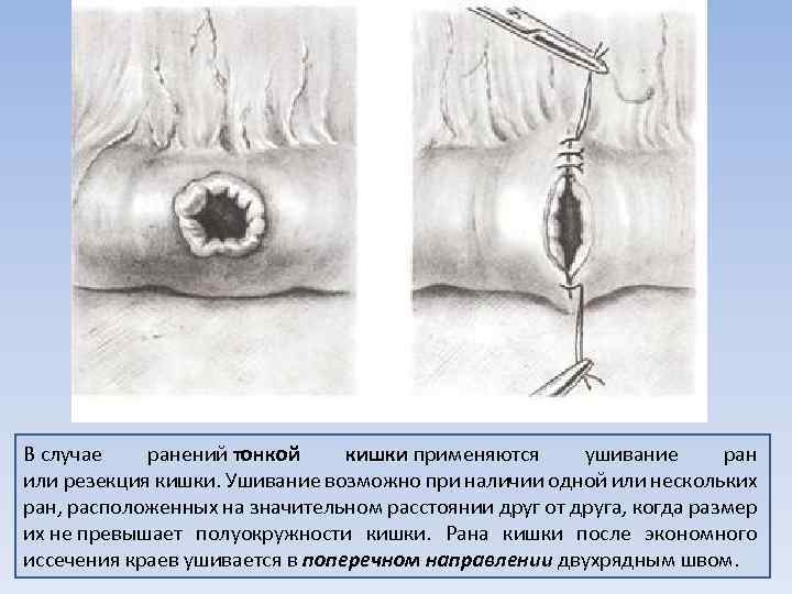 В случае ранений тонкой кишки применяются ушивание ран кишки или резекция кишки. Ушивание возможно