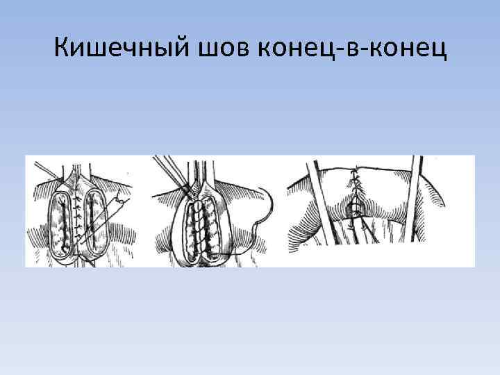 Кишечный шов конец-в-конец 