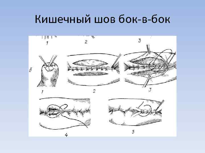 Кишечный шов бок-в-бок 