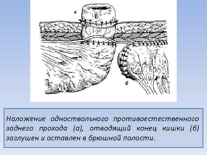 Наложение одноствольного противоестественного заднего прохода (а), отводящий конец кишки (б) заглушен и оставлен в