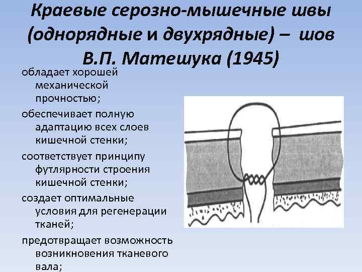 Краевые серозно-мышечные швы (однорядные и двухрядные) – шов В. П. Матешука (1945) обладает хорошей