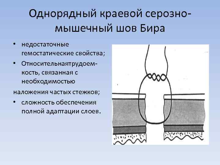 Однорядный краевой серозномышечный шов Бира • недостаточные гемостатические свойства; • Относительнаятрудоемкость, связанная с необходимостью