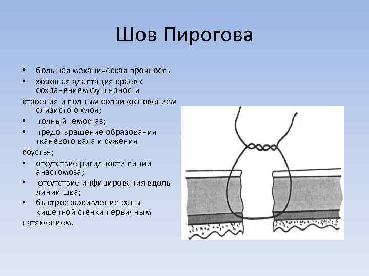 Шов Пирогова большая механическая прочность хорошая адаптация краев с сохранением футлярности строения и полным