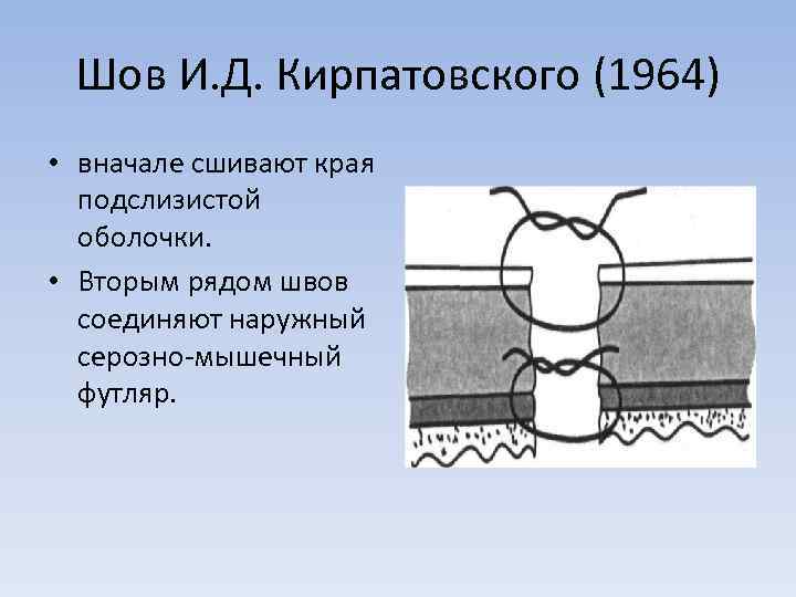 Шов И. Д. Кирпатовского (1964) • вначале сшивают края подслизистой оболочки. • Вторым рядом