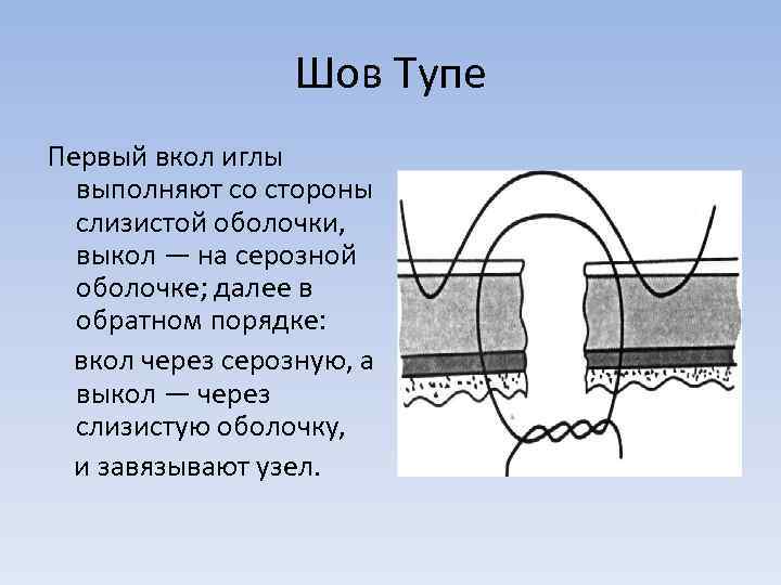 Шов Тупе Первый вкол иглы выполняют со стороны слизистой оболочки, выкол — на серозной