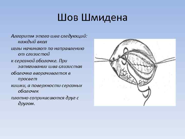 Шов Шмидена Алгоритм этого шва следующий: каждый вкол иглы начинают по направлению от слизистой