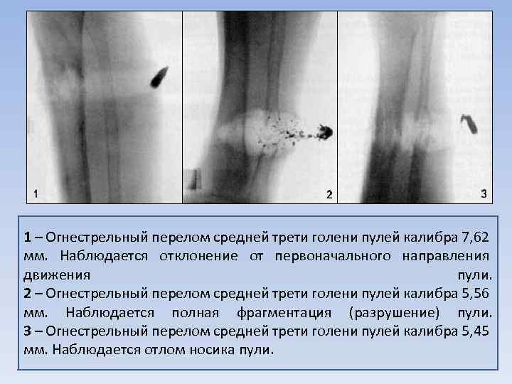 Дырчатый перелом