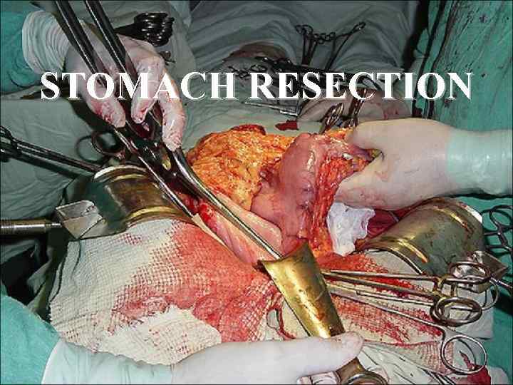 STOMACH RESECTION 