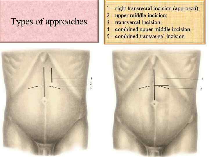 Types of approaches 1 – right transrectal incision (approach); 2 – upper middle incision;