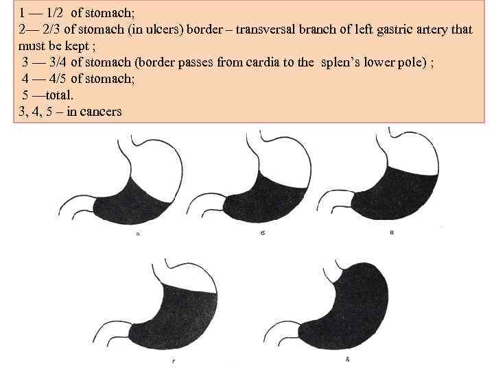 1 — 1/2 of stomach; 2— 2/3 of stomach (in ulcers) border – transversal