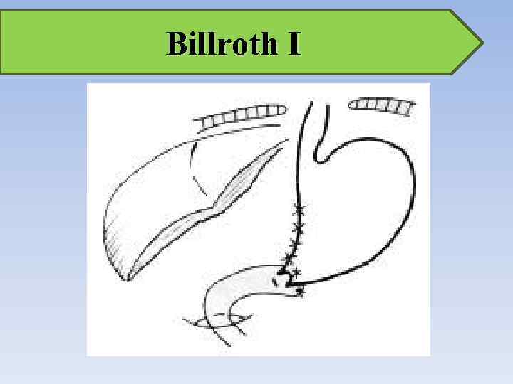 Billroth I 