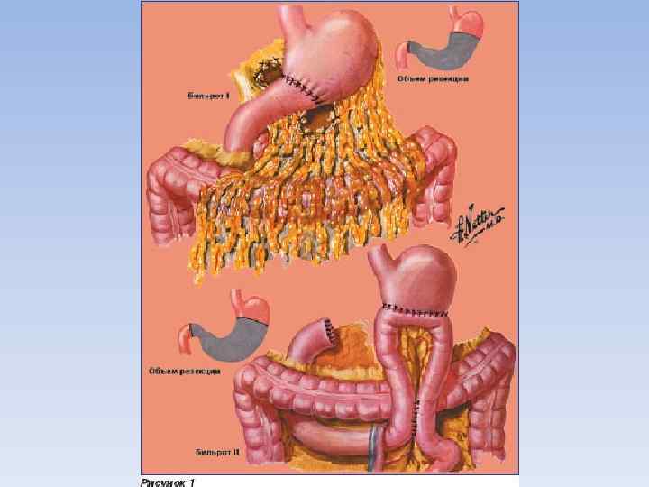 Резекция желудка анемия. Оперированный желудок по Бильрот 2.
