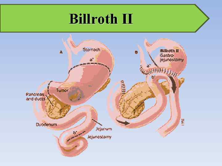 Billroth II 