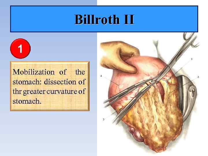 Billroth II 1 Mobilization of the stomach: dissection of thr greater curvature of stomach.