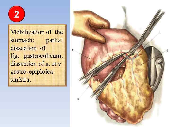 2 Mobilization of the stomach: partial dissection of lig. gastrocolicum, dissection of a. et