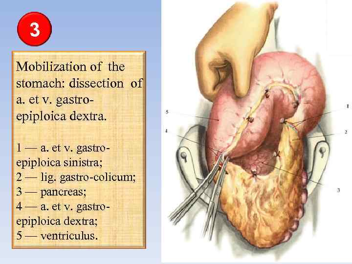 3 Mobilization of the stomach: dissection of a. et v. gastroepiploica dextra. 1 —