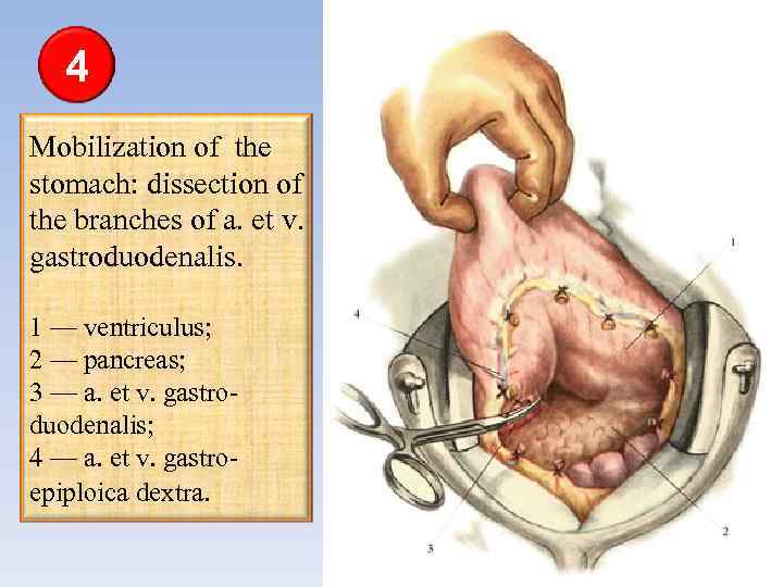 4 Mobilization of the stomach: dissection of the branches of a. et v. gastroduodenalis.