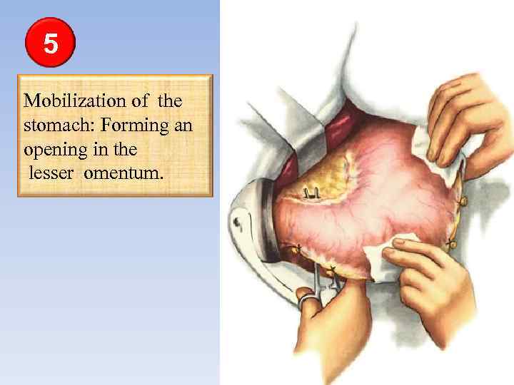 5 Mobilization of the stomach: Forming an opening in the lesser omentum. 