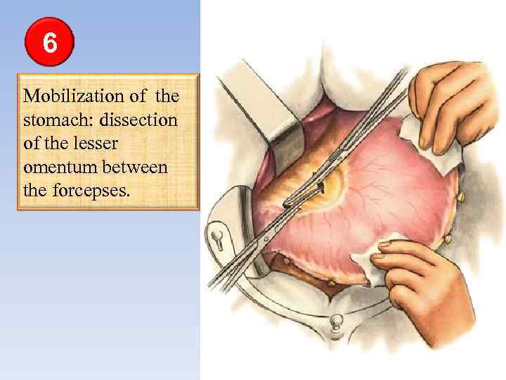 6 Mobilization of the stomach: dissection of the lesser omentum between the forcepses. 