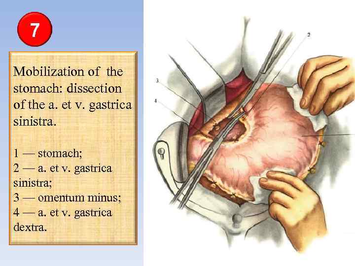 7 Mobilization of the stomach: dissection of the а. et v. gastrica sinistra. 1