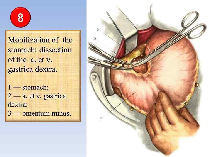 8 Mobilization of the stomach: dissection of the a. et v. gastrica dextra. 1