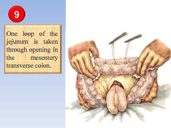 9 One loop of the jejunum is taken through opening in the mesentery transverse