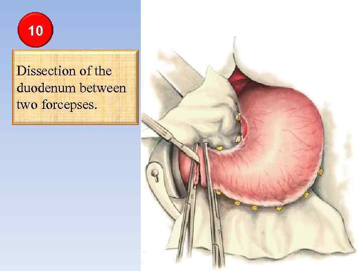 10 Dissection of the duodenum between two forcepses. 