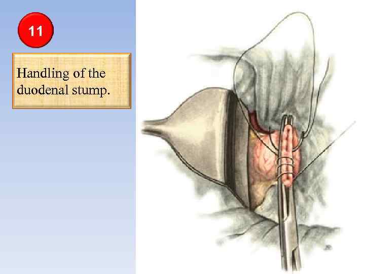 11 Handling of the duodenal stump. 