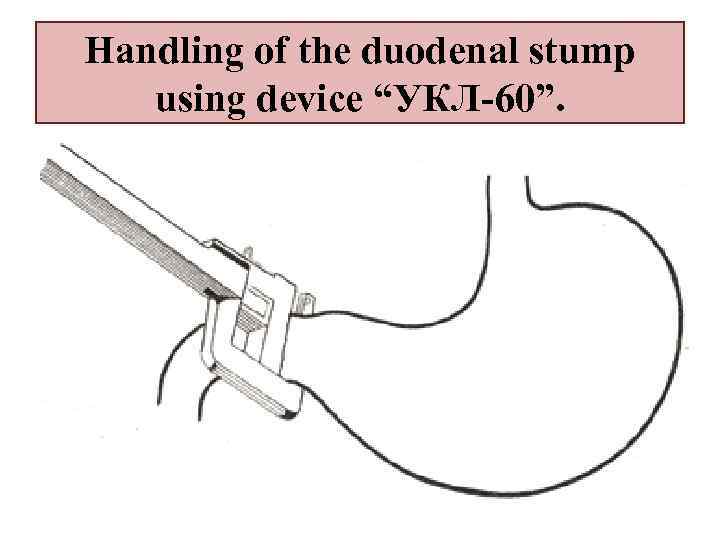 Handling of the duodenal stump using device “УКЛ-60”. 