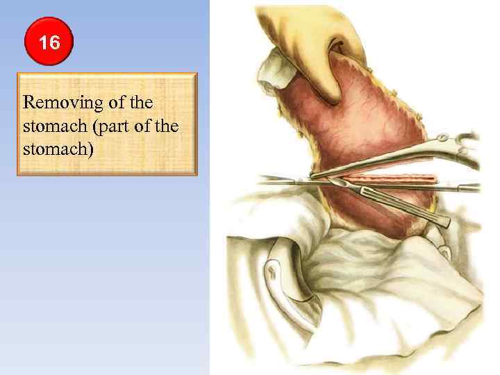 16 Removing of the stomach (part of the stomach) 