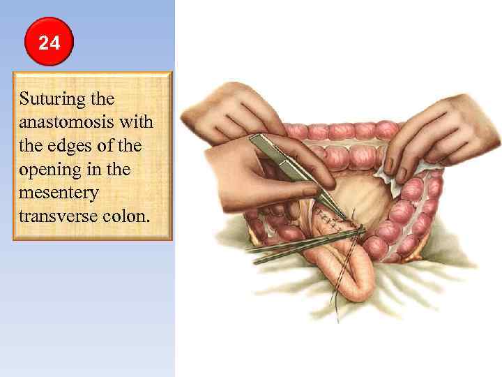 24 Suturing the anastomosis with the edges of the opening in the mesentery transverse