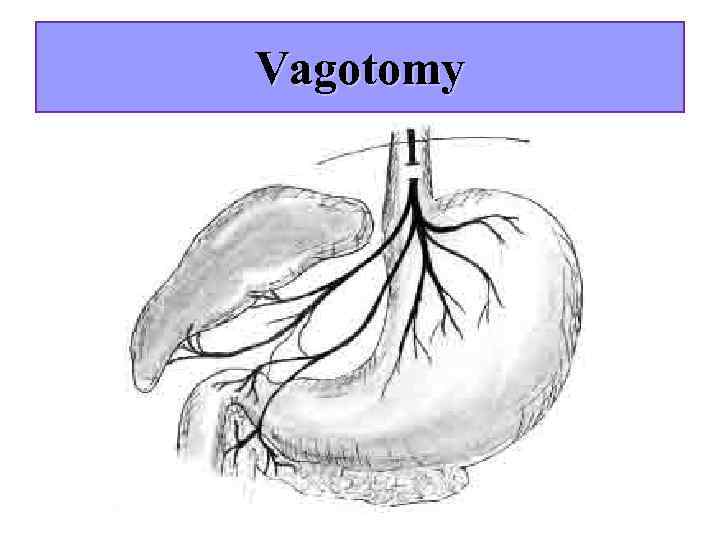 Vagotomy 