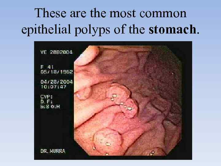 These are the most common epithelial polyps of the stomach. 