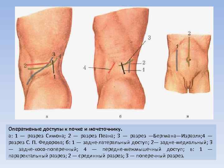 Оперативные доступы к почке и мочеточнику. а: 1 — разрез Симона; 2 — разрез